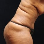 Tummy Tuck Before & After Patient #11539