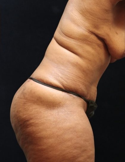 Tummy Tuck Before & After Patient #11539