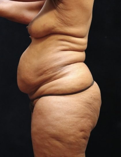 Tummy Tuck Before & After Patient #11539
