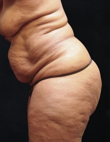 Tummy Tuck Before & After Patient #11539
