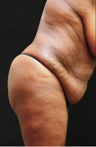 Tummy Tuck Before & After Patient #11521