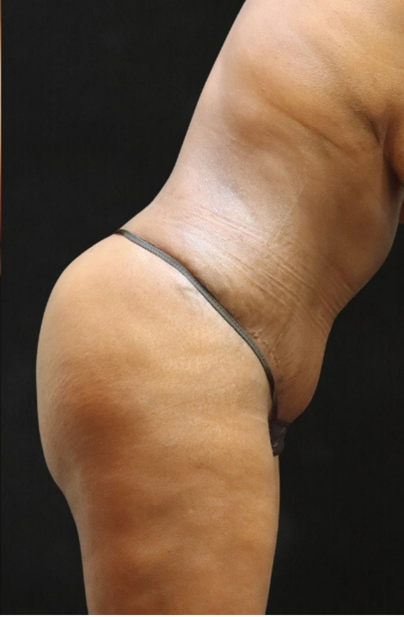 Tummy Tuck Before & After Patient #11521