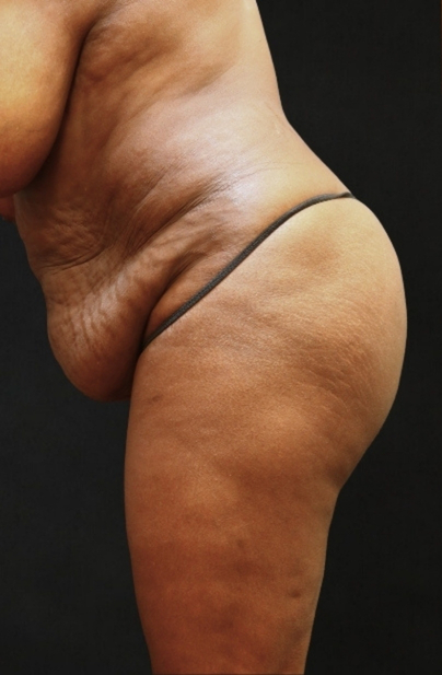 Tummy Tuck Before & After Patient #11521