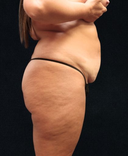 Tummy Tuck Before & After Patient #11522