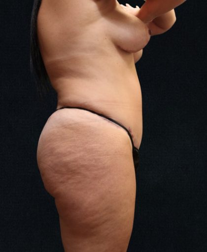 Tummy Tuck Before & After Patient #11522