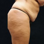 Tummy Tuck Before & After Patient #11522
