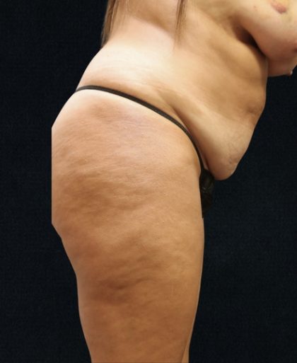 Tummy Tuck Before & After Patient #11522