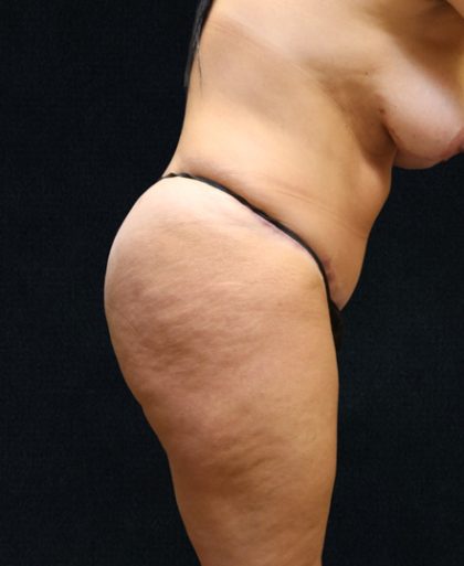 Tummy Tuck Before & After Patient #11522