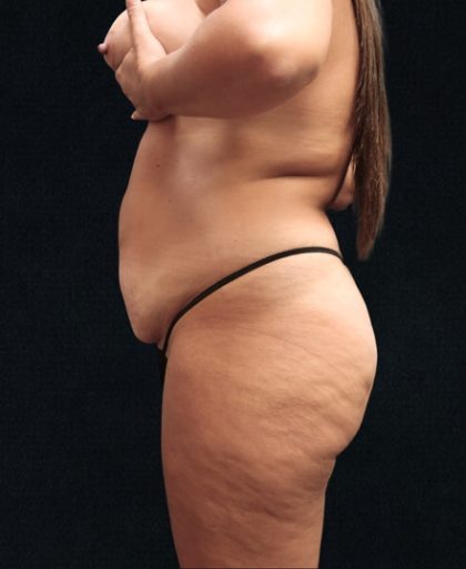 Tummy Tuck Before & After Patient #11522