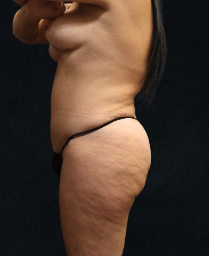 Tummy Tuck Before & After Patient #11522