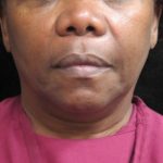 Fat Transfer Before & After Patient #12070
