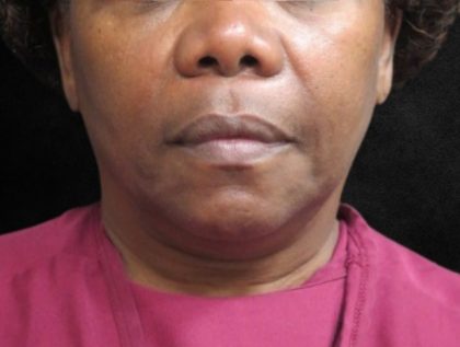 Fat Transfer Before & After Patient #12070