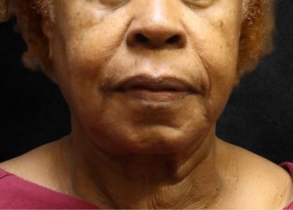 Fat Transfer Before & After Patient #12071