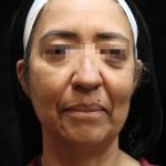 Fat Transfer Before & After Patient #12064