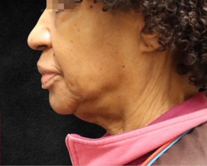 Fat Transfer Before & After Patient #12069