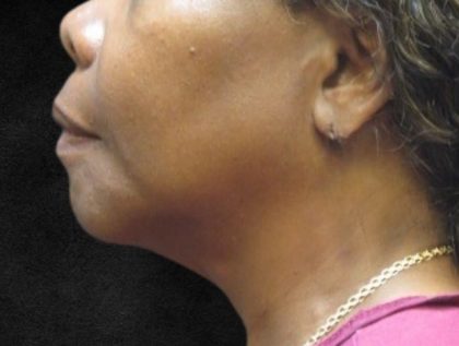 Fat Transfer Before & After Patient #12070
