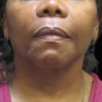 Fat Transfer Before & After Patient #12070