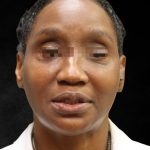 Fat Transfer Before & After Patient #12062
