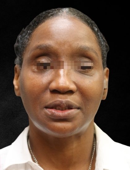 Fat Transfer Before & After Patient #12062