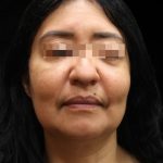 Fat Transfer Before & After Patient #12064