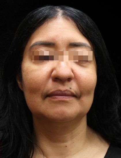 Fat Transfer Before & After Patient #12064