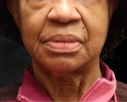 Fat Transfer Before & After Patient #12069