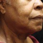 Fat Transfer Before & After Patient #12071