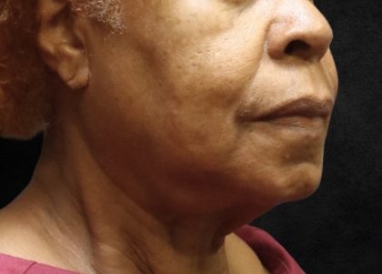 Fat Transfer Before & After Patient #12071