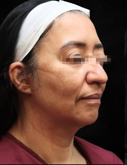 Fat Transfer Before & After Patient #12064