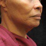 Fat Transfer Before & After Patient #12068