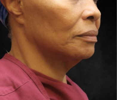 Fat Transfer Before & After Patient #12068