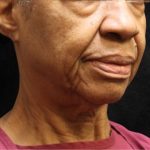 Fat Transfer Before & After Patient #12069