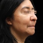 Fat Transfer Before & After Patient #12064