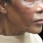 Fat Transfer Before & After Patient #12067