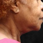 Fat Transfer Before & After Patient #12071
