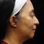 Fat Transfer Before & After Patient #12064