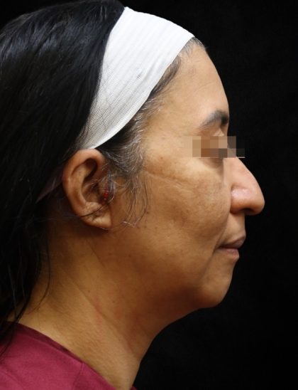 Fat Transfer Before & After Patient #12064