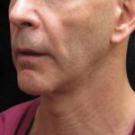 Fat Transfer Before & After Patient #12065