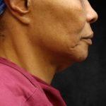 Fat Transfer Before & After Patient #12068