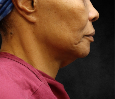 Fat Transfer Before & After Patient #12068