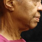 Fat Transfer Before & After Patient #12069