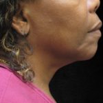 Fat Transfer Before & After Patient #12070