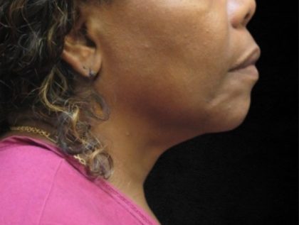 Fat Transfer Before & After Patient #12070