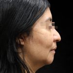Fat Transfer Before & After Patient #12064