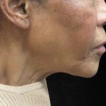 Fat Transfer Before & After Patient #12067