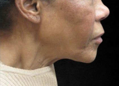 Fat Transfer Before & After Patient #12067
