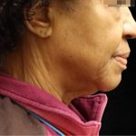 Fat Transfer Before & After Patient #12069