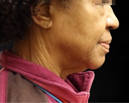 Fat Transfer Before & After Patient #12069