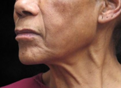 Fat Transfer Before & After Patient #12067
