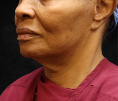Fat Transfer Before & After Patient #12068